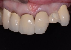 Complete Smile Makeover patient 10