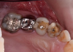 Complete Smile Makeover patient 14