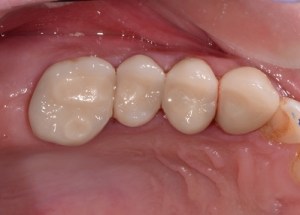 Complete Smile Makeover patient 14