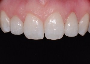 Complete Smile Makeover patient 9