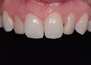 Complete Smile Makeover patient 9