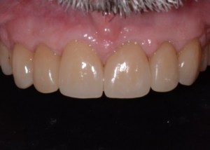 Complete Smile Makeover patient 3