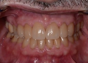 Complete Smile Makeover patient 3
