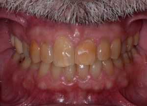 Complete Smile Makeover patient 3