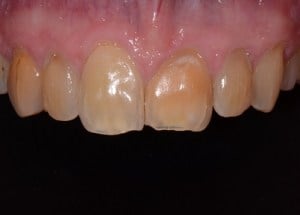 Complete Smile Makeover patient 3