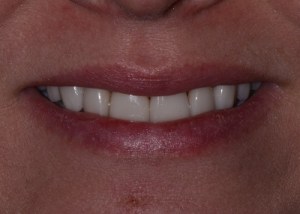 Complete Smile Makeover patient 2