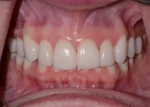 Complete Smile Makeover patient 2