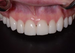 Complete Smile Makeover patient 2