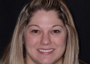 Complete Smile Makeover patient 2