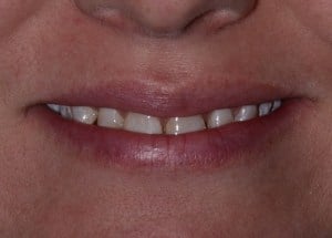 Complete Smile Makeover patient 2