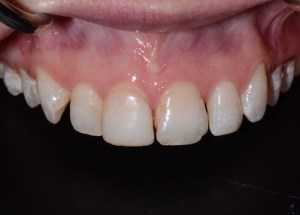 Complete Smile Makeover patient 2