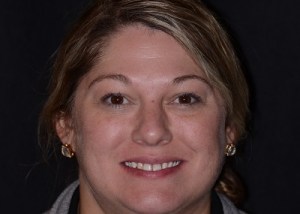 Complete Smile Makeover patient 2