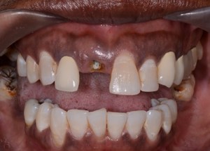 Crowns patient 1
