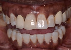 Crowns patient 1
