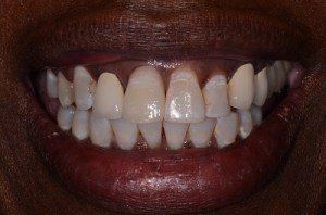 Crowns patient 1