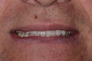 Complete Smile Makeover patient 7