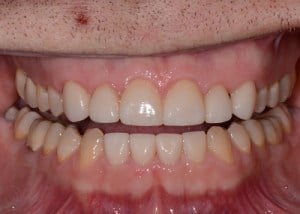 Complete Smile Makeover patient 7