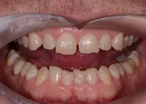 Complete Smile Makeover patient 7