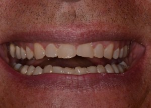Complete Smile Makeover patient 7