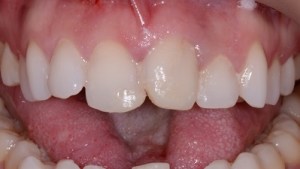 Complete Smile Makeover patient 13